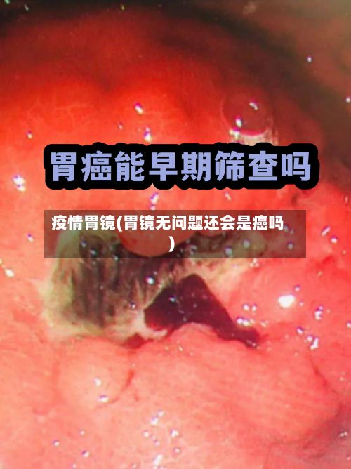 疫情胃镜(胃镜无问题还会是癌吗)-第2张图片